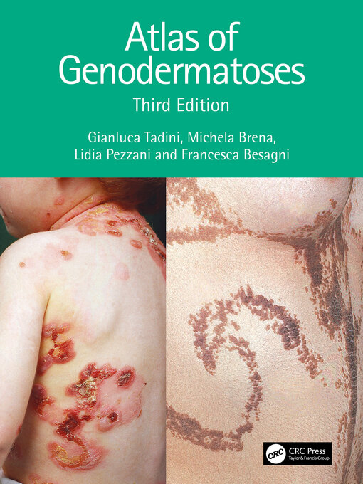 Title details for Atlas of Genodermatoses by Gianluca Tadini - Wait list